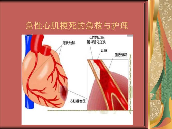 生活百科心肌梗死（心肌梗死的）